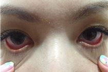 Tại sao mắt lại bị đỏ khi nối mi? - kiến thức nối mi