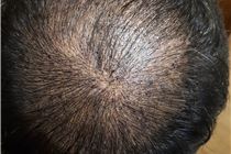 Điêu khắc tóc hói, tóc thưa cho nam trẻ trung và hợp lý