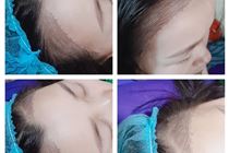 Điêu khắc đường chân tóc, thêu tóc 8d Điêu khắc đường chân tóc, thêu tóc 8d