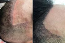 Điêu khắc tóc, xăm chân tóc giữ được bao lâu? Điêu khắc tóc, xăm chân tóc giữ được bao lâu?