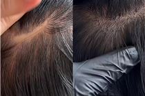 Điêu khắc chân tóc che hói bằng công nghệ hairstroke