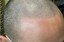 XĂM CHẠM HẠT CHÂN TÓC CHE CHAN TÓC HÓI