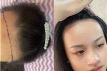 Điêu Khắc Tóc, làm dày chân tóc một cách tự nhiên  vùng hói trán và đỉnh đầu