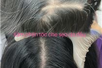 Xăm Chân Tóc Che Sẹo Da Đầu Xăm Chân Tóc Che Sẹo Da Đầu