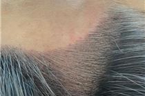 Điêu khắc chân tóc – công nghệ làm đẹp mới khắc phục cực hay tóc thưa, hói và mái bò liếm