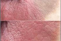 Hướng dẫn phun hồng nhũ hoa Hướng dẫn phun hồng nhũ hoa