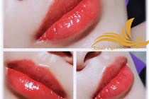 Phun môi tế bào gốc sau khử thâm môi/phun môi Phun môi tế bào gốc sau khử thâm môi/phun môi