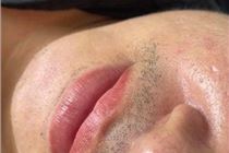 Phân tích va chia sẻ kiến thức khử thâm môi nam  Phân tích va chia sẻ kiến thức khử thâm môi nam