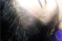 Điêu khắc tóc hói, dệt tóc 8D tại Tít Mi Điêu khắc tóc hói, dệt tóc 8D tại Tít Mi