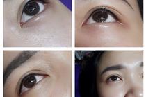 Thêu mí mở tròng kỹ thuật mới nhất hiện nay