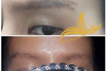 Vì Sao xoá lông mày bằng laser màu sẽ chuyển từ xanh đen sang nâu đỏ. Vì Sao xoá lông mày bằng laser màu sẽ chuyển từ xanh đen sang nâu đỏ.