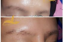 Xóa xăm nhanh chóng, đơn giản và nhẹ nhàng 