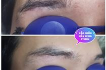 Chia sẻ các xóa chân mày bằng tia lazer mà không bị cháy lông Chia sẻ các xóa chân mày bằng tia lazer mà không bị cháy lông