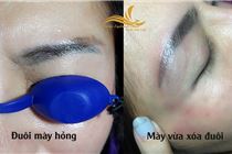 Xóa xăm chân mày, mí mắt trổ xanh, đỏ an toàn và hiệu quả tại Hà Nội