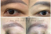 Xoá xăm lông mày, mí mắt một lần có hết được không? 