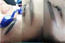 Xóa xăm trên mọi vị trí chân mày, môi, mí, hình trên người