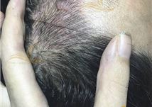 Điêu khắc tóc che sẹo