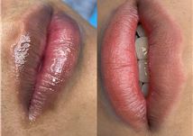 Khử thâm moi nam nhẹ nhàng phù hơp với giới tính