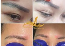 Liệu trình xóa chân mày cũ hỏng bằng lazer 