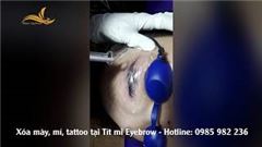 Hướng dẫn Xóa Xăm tốt nhất tại Tít mi Eyebrow
