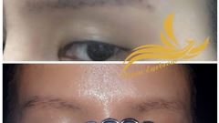 Vì Sao xoá lông mày bằng laser màu sẽ chuyển từ xanh đen sang nâu đỏ. Vì Sao xoá lông mày bằng laser màu sẽ chuyển từ xanh đen sang nâu đỏ.