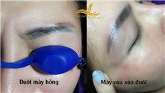 Xóa Xăm Chân Mày An toàn và hiệu quả tại Hà Nội Xóa Xăm Chân Mày An toàn và hiệu quả tại Hà Nội