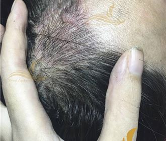 Điêu khắc tóc che sẹo