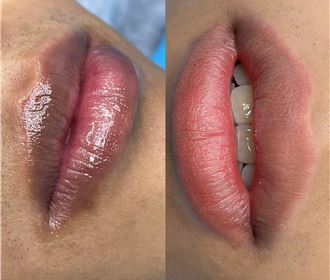 Khử thâm moi nam nhẹ nhàng phù hơp với giới tính