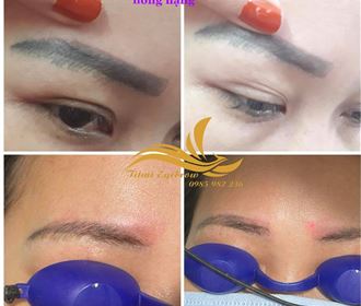 Liệu trình xóa chân mày cũ hỏng bằng lazer 