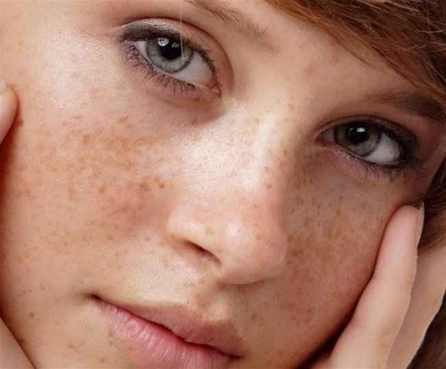 vì sao da bị nám 