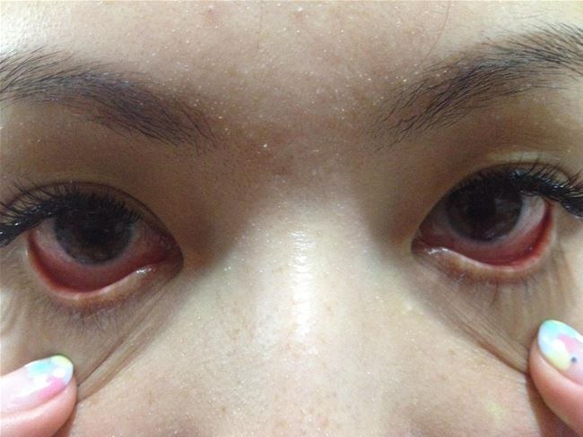 tại sao mắt lại đỏ khi nối mi