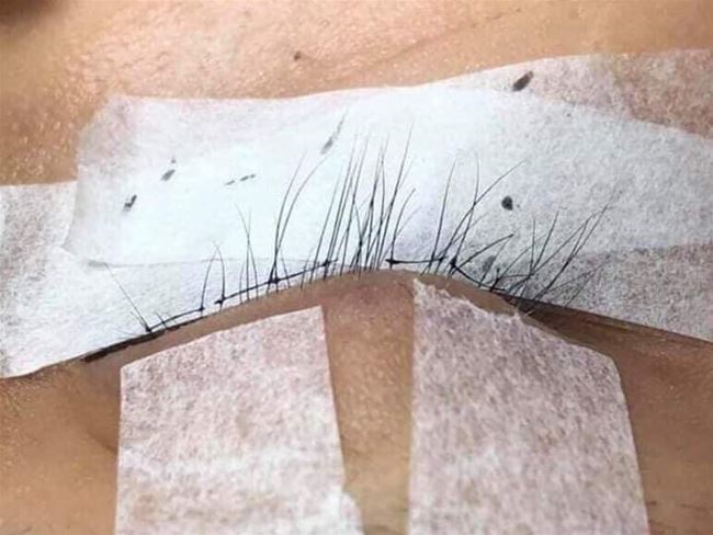 phương pháp vắt cầu qua chân mi khắc phục mi thưa yếu