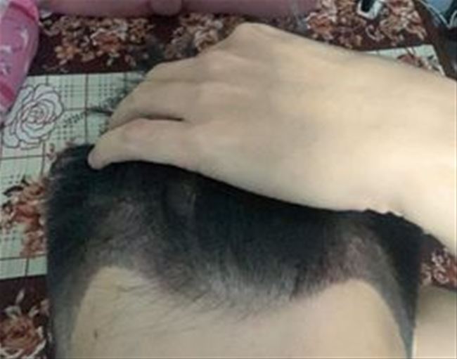 điêu khắc chân tóc vùng chữ M cho nam