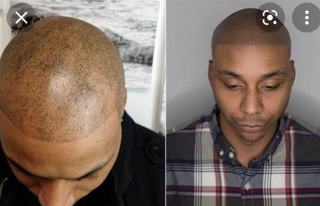 mô phỏng kỹ thuật cham hạt chân tóc trên nền da đâu bị hói và thưa tóc