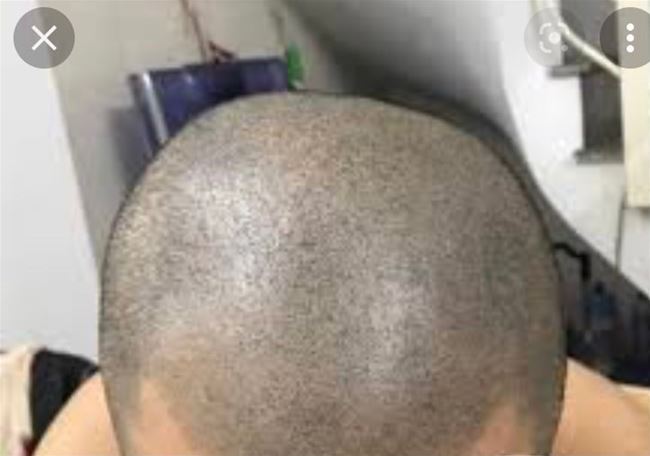 mô phỏng kỹ thuật cham hạt chân tóc trên nền da đâu bị hói và thưa tóc