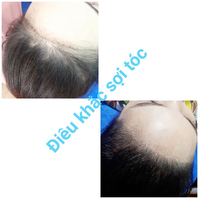 Điêu khắc tóc với công nghệ Hair Simulation/Microblading Scalp.  Sẽ giúp bạn khắc trị việc hói tóc, thưa tóc. Thích hợp cho cả nam và nữ Điêu khắc tóc với công nghệ Hair Simulation/Microblading Scalp.  Sẽ giúp bạn khắc trị việc hói tóc, thưa tóc. Thích hợp cho cả nam và nữ