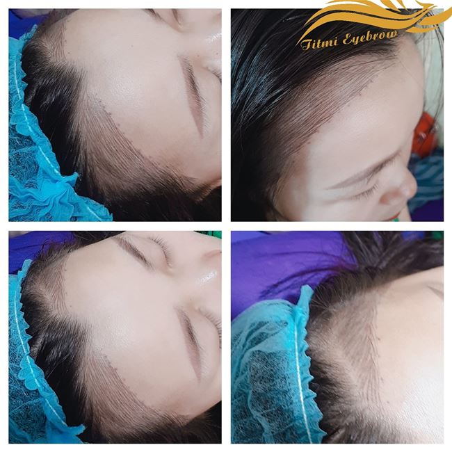 điêu khắc dệt sợi tóc 8d che vùng tóc thưa hói