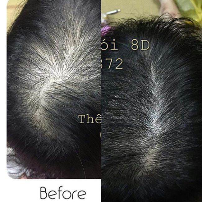 Khắc tóc che đường ngôi giữa bị thưa Khắc tóc che đường ngôi giữa bị thưa