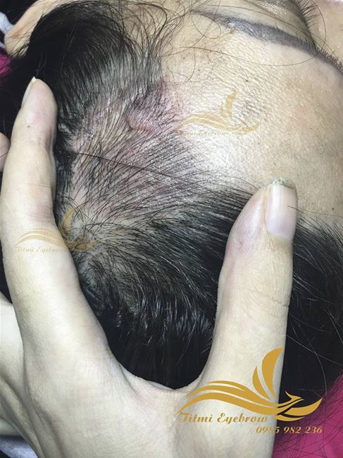 vùng sẹo của khách nữ sau khi đã được điêu khắc vùng sẹo của khách nữ sau khi đã được điêu khắc