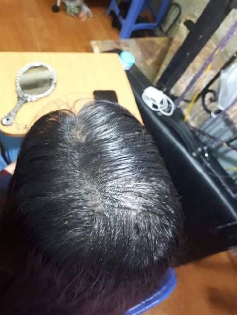 Vùng ngôi thưa  của nữ khách hàng được xếp sợi tỉ mỉ , điêu khắc tóc tại Tít Mi Vùng ngôi thưa  của nữ khách hàng được xếp sợi tỉ mỉ , điêu khắc tóc tại Tít Mi