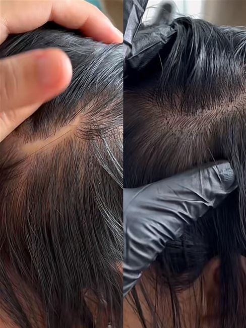 điêu khắc hairstrocke tạo sợi tóc che sẹo cho khách hàng điêu khắc hairstrocke tạo sợi tóc che sẹo cho khách hàng