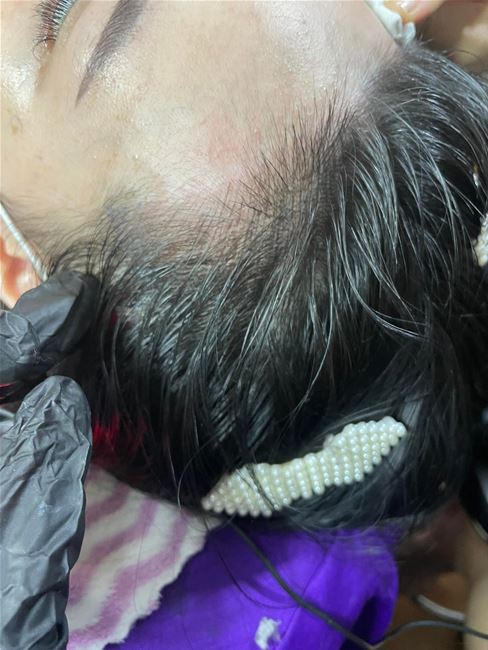 điêu khắc bằng hairstrocke rất hữu ịch có nền da khó như da sẹo da dâu