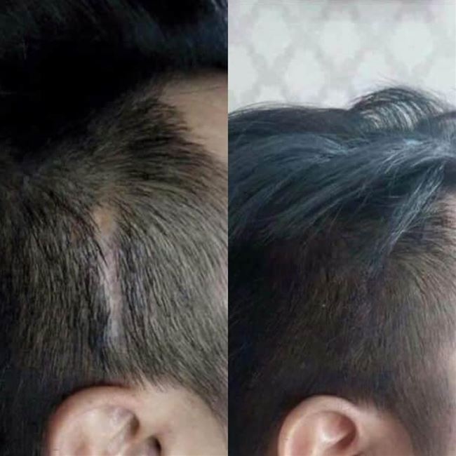 điêu khắc chân tóc hói do sẹo để lại
