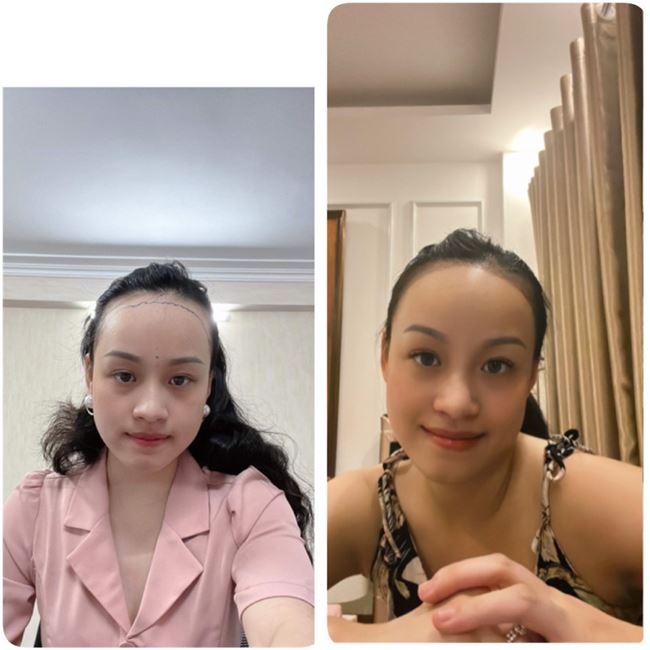 trước và sau khi điêu khắc sợi tóc vùng mái chữ M