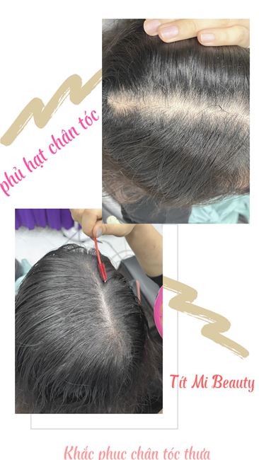Phủ hạt chân tóc vùng ngôi mái cho nữ Phủ hạt chân tóc vùng ngôi mái cho nữ