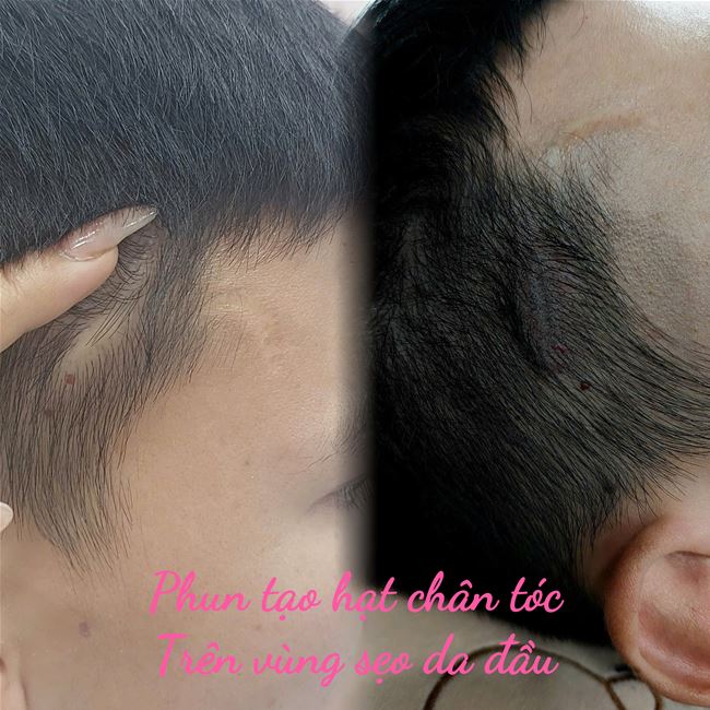 phun xăm chân tóc tạo hạt giống như nang tóc che phủ trên nên sẹo trắng da đầu