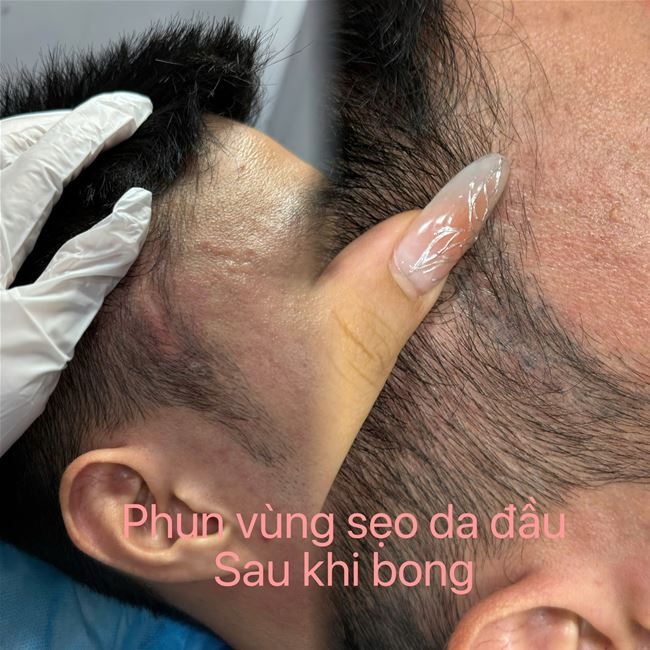 phun xăm chân tóc tạo hạt giống như nang tóc che phủ trên nên sẹo trắng da đầu