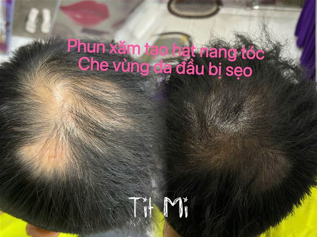 phun xăm chân tóc tạo hạt giống như nang tóc che phủ trên nên sẹo trắng da đầu