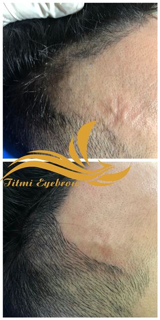 dịch vụ điêu khắc tóc vùng hói nam, nữ