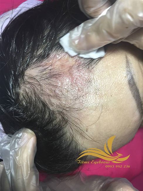 vùng tóc bị sẹo trước khi điêu khắc vùng tóc bị sẹo trước khi điêu khắc